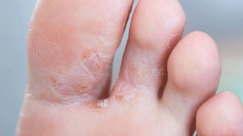 Dùng nước từ rau răm giã nát để chấm lên vết thương có thể hỗ trợ điều trị bệnh nước ăn chân