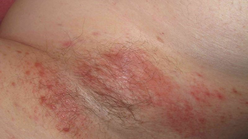 Rau răm hỗ trợ điều trị nấm trên một số loại nấm da