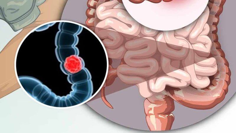 Tinh dầu nghệ có khả năng chống lại ung thư ruột kết Tinh dầu nghệ có khả năng chống lại ung thư ruột kết