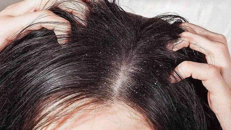Dùng tinh dầu nghệ làm giảm gàu, nhiễm nấm và ngứa da đầu Dùng tinh dầu nghệ làm giảm gàu, nhiễm nấm và ngứa da đầu