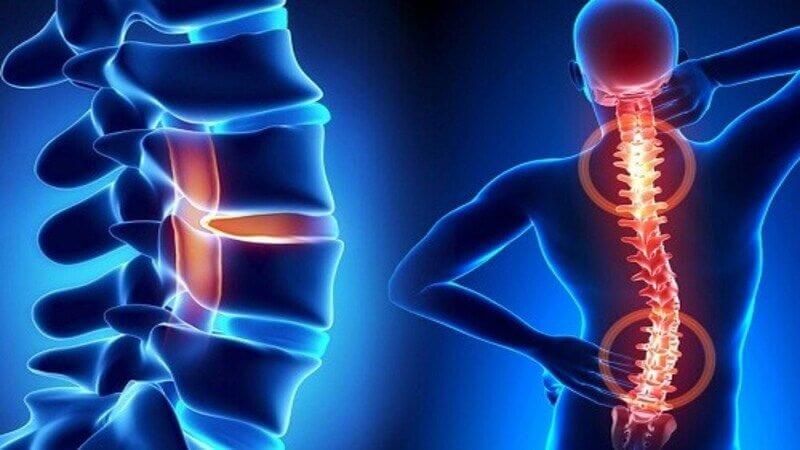 Nghệ có khả năng giúp giảm đau, viêm khớp Nghệ có khả năng giúp giảm đau, viêm khớp