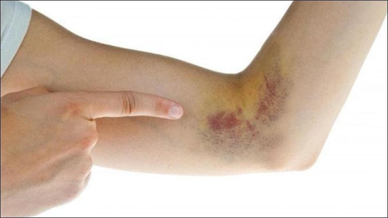 Triệu chứng chính của thiếu vitamin K là xuất huyết quá mức