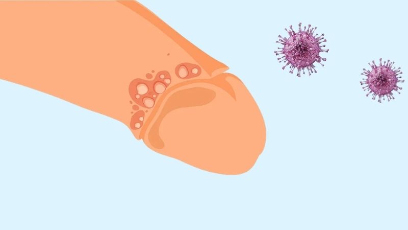 Mụn rộp sinh dục g&acirc;y ra cụm mụn nước nhỏ chứa dịch m&agrave;u trắng hoặc trong suốt