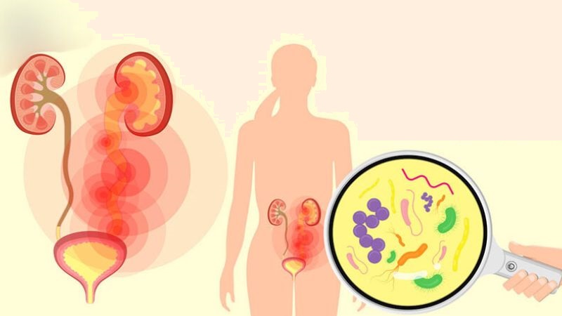 Cần điều trị ổn định nhiễm khuẩn hệ tiết niệu trước mới được tiến hành tán sỏi qua da Cần điều trị ổn định nhiễm khuẩn hệ tiết niệu trước mới được tiến hành tán sỏi qua da