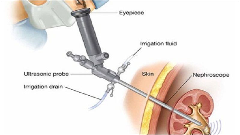 Bệnh nhân tán sỏi qua da cần thực hiện gây mê toàn thân Bệnh nhân tán sỏi qua da cần thực hiện gây mê toàn thân