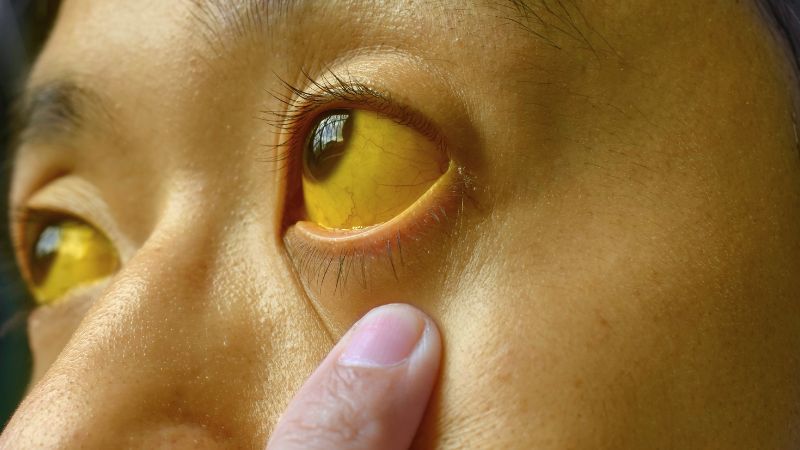 Bài thuốc kết hợp chè vằng và ngấy hương có thể chữa vàng da