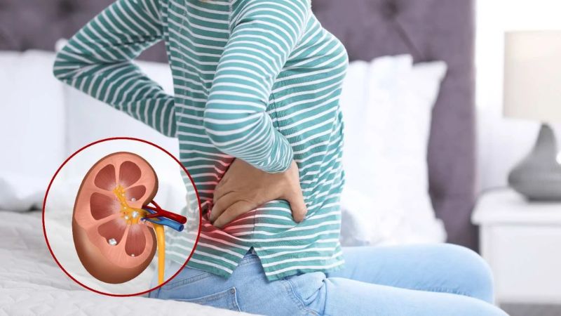 Đau h&ocirc;ng b&ecirc;n phải c&oacute; thể do sỏi thận g&acirc;y ra