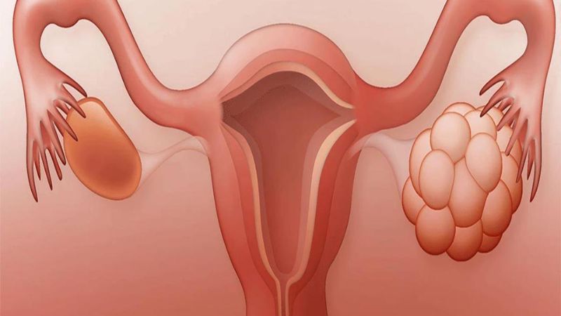 Đau h&ocirc;ng b&ecirc;n phải ở nữ c&oacute; thể li&ecirc;n quan đến u nang buồng trứng