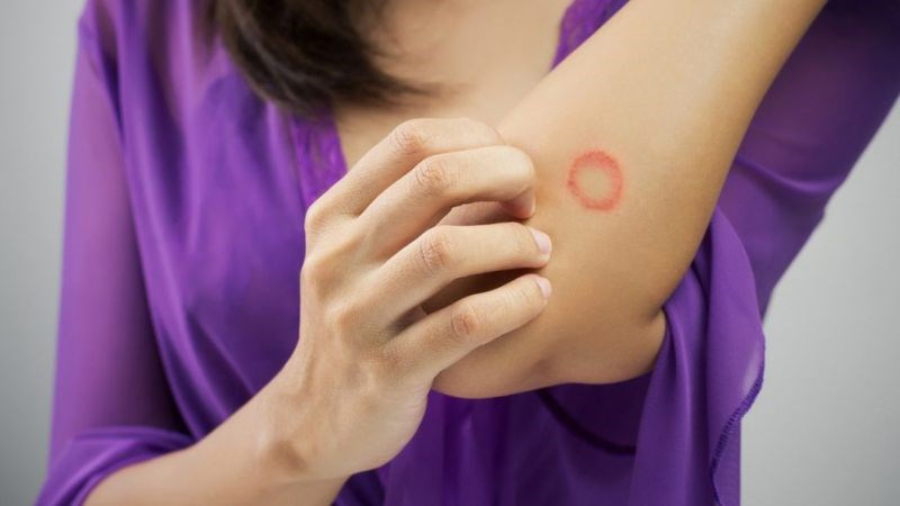 Lác đồng tiền thường lây lan qua tiếp xúc trực tiếp với da của người bị nhiễm