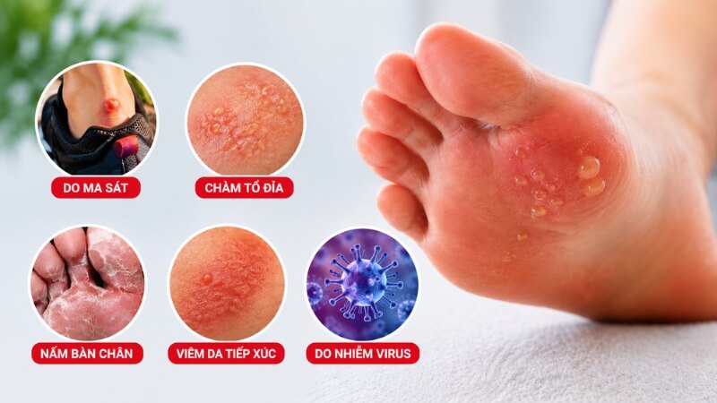 Mụn nước ở chân có thể xuất hiện do ma sát hoặc do nguyên nhân bệnh lý Mụn nước ở chân có thể xuất hiện do ma sát hoặc do nguyên nhân bệnh lý