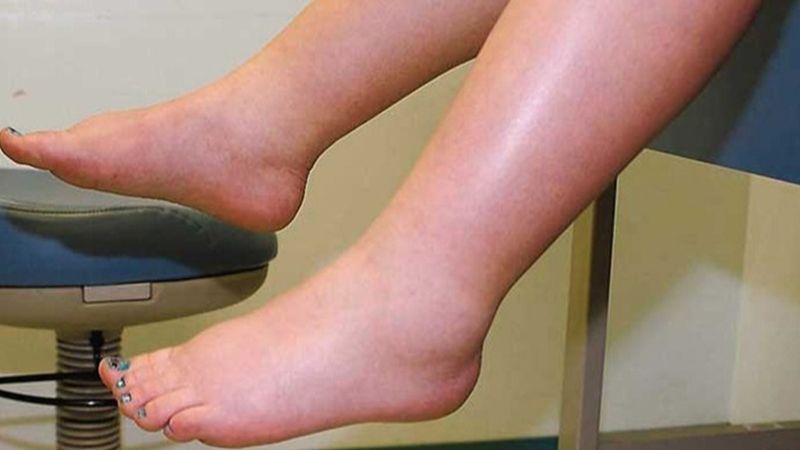 Dưa hấu có tính lợi tiểu, giúp bà bầu giảm phù chân