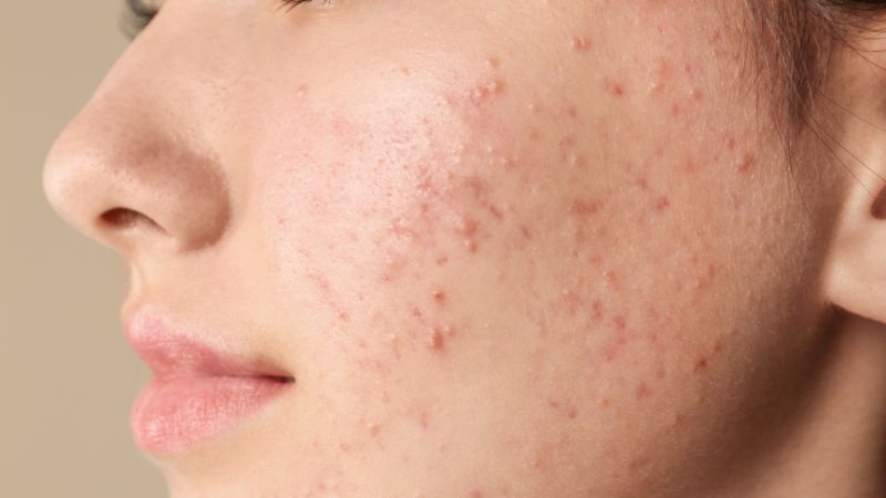 Trong giai đoạn mụn lành, vùng da có thể để lại vùng tối gây nên tình trạng thâm mụn