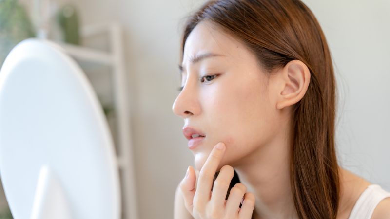 Vết thâm mụn có thể tự mờ dần trong 6 - 12 tháng