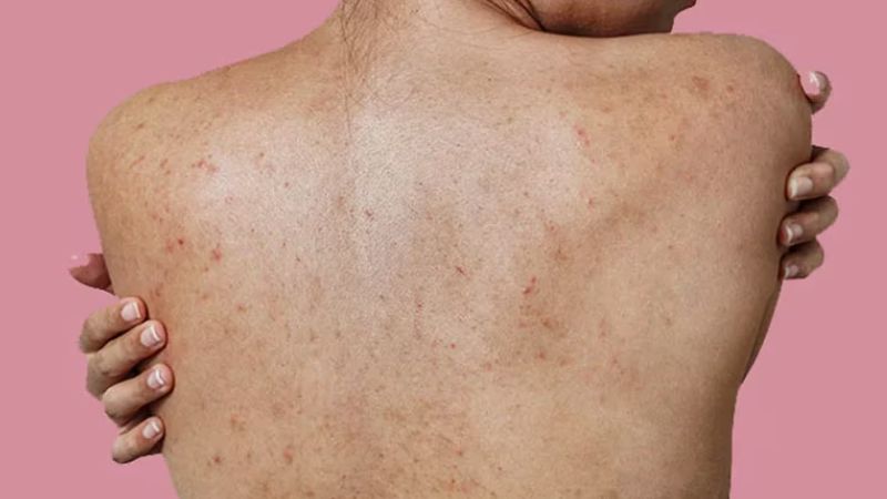 Kết hợp các thành phần sữa tắm và thuốc trị mụn lưng để tăng hiệu quả 