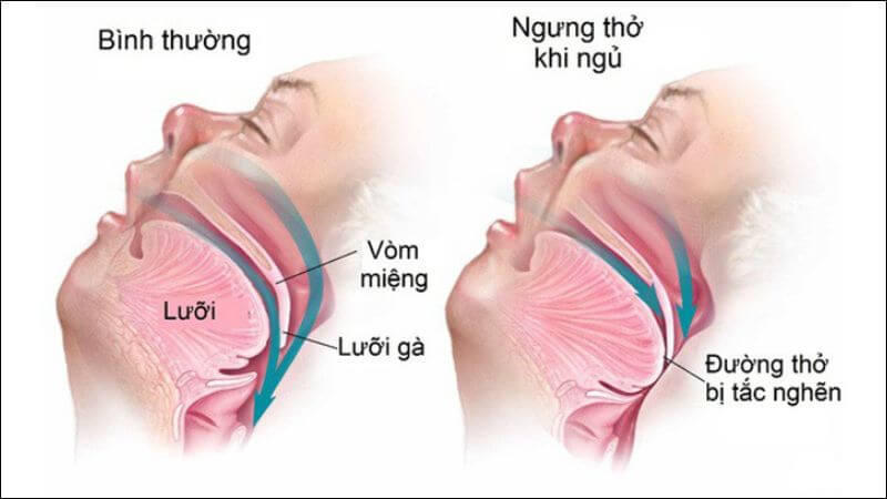 Khi luồng khí qua miệng và mũi bị chặn sẽ gây nên chứng ngáy ngủ
