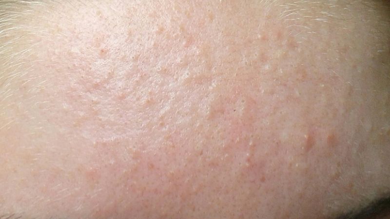 Mụn ẩn có thể do di truyền