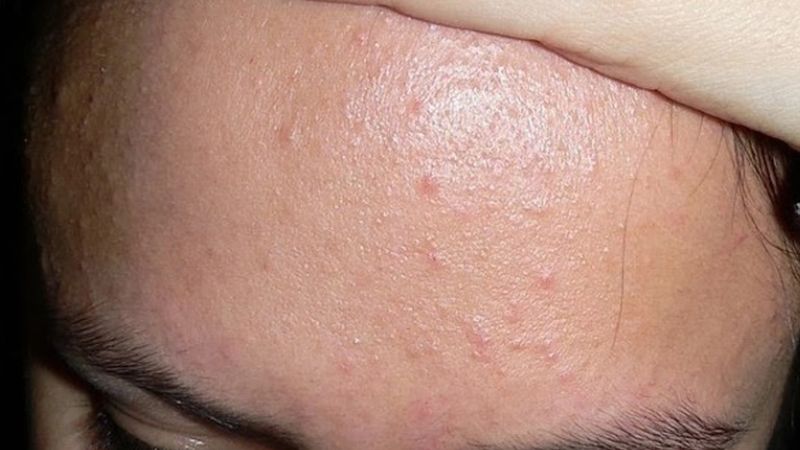 Mụn ẩn là những nốt mụn 