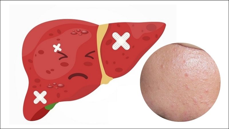 Khi chức năng gan suy giảm có thể gây ra mụn ẩn, mụn trứng cá hoặc mụn nang