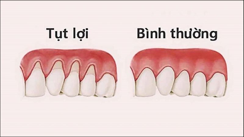 Tụt lợi làm cho răng dễ ê buốt khi ăn uống nóng hoặc lạnh