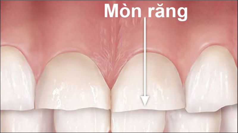 Mòn răng là tình trạng lớp men răng ngoài cùng bị mất đi dẫn đến ê buốt