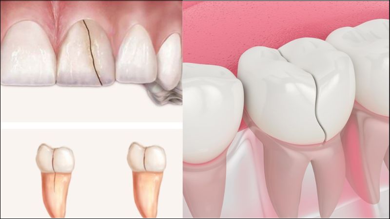 Răng bị nứt thường gây ra cơn đau nhức hơn so với cảm giác ê buốt