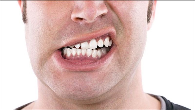 Thói quen nghiến răng có thể làm mòn men răng, gây ê buốt răng