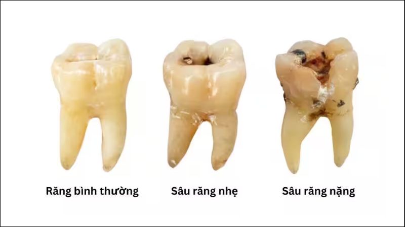 Sâu răng dẫn đến tình trạng ê buốt hoặc đau nhức khi ăn đồ nóng, lạnh