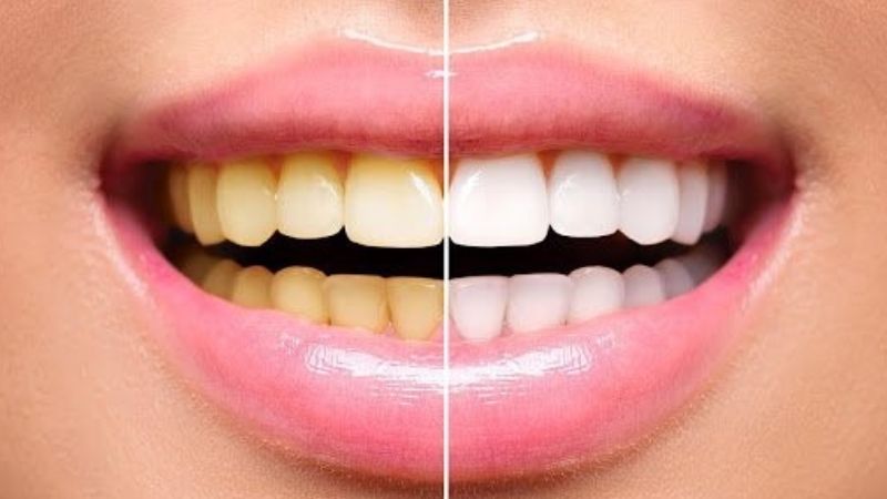 Răng ê buốt có thể là tác dụng phụ tạm thời của quá trình làm trắng răng