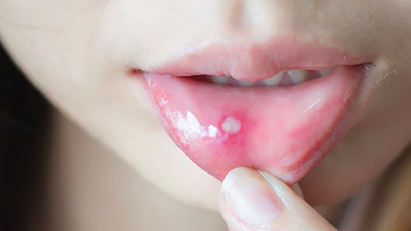 Nhiệt miệng là một tổn thương niêm mạc miệng thường gặp gây mụn nước trong miệng