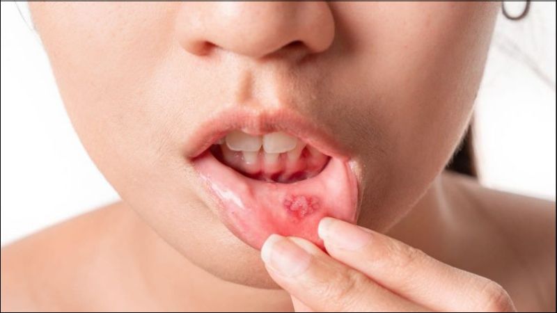  Dị ứng hóa chất, mỹ phẩm, thực phẩm có thể gây ra mụn nước trong miệng