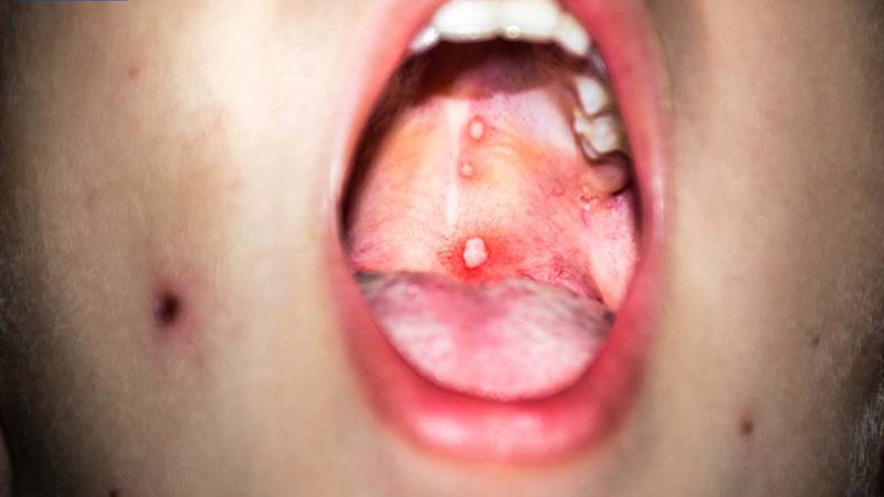  Người bị thủy đậu còn có thể bị mọc mụn nước trong miệng
