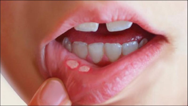 Loét miệng thường xuất hiện dưới dạng những vết loét nhỏ 