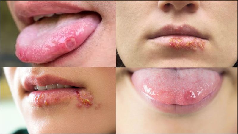  Triệu chứng đầu tiên của bệnh mụn rộp sinh dục là các vết loét nhỏ trong miệng
