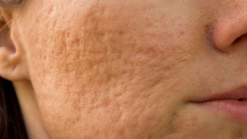 Sẹo rỗ l&agrave; dạng sẹo l&otilde;m xuất hiện khi cấu tr&uacute;c collagen, elastin dưới da bị tổn thương