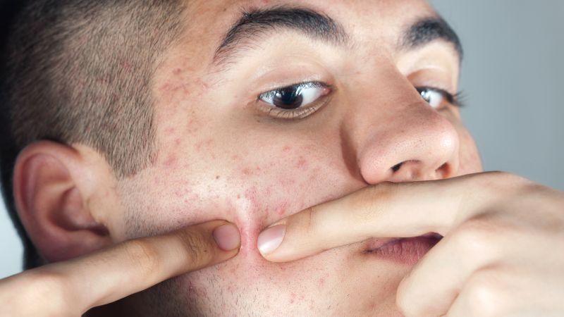 Người thường xuy&ecirc;n nặn mụn sai c&aacute;ch c&oacute; nguy cơ cao bị sẹo rỗ