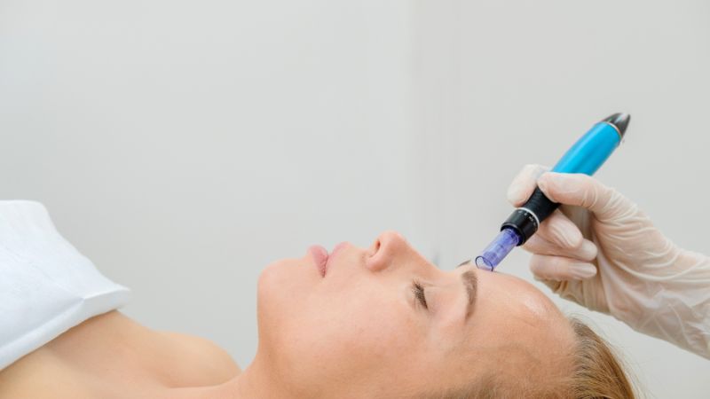 B&aacute;c sĩ c&oacute; thể chỉ định phương ph&aacute;p lăn kim để điều trị sẹo rỗ