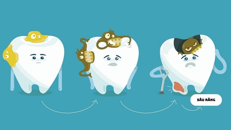 Sâu răng là một vấn đề liên quan đến sức khỏe răng miệng phổ biến trên thế giới