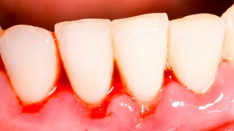 Nướu có thể bị viêm chảy máu khi sâu răng