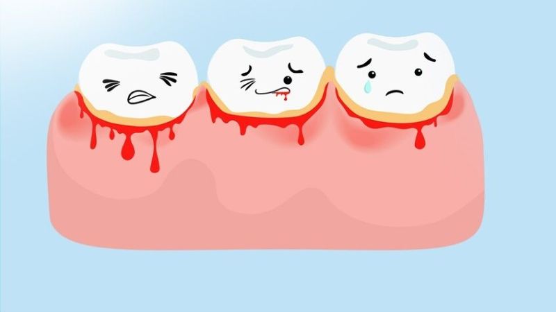 Nướu chảy máu có thể là dấu hiệu sâu răng
