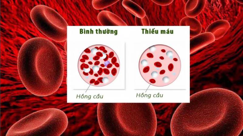 Ăn trứng giúp ngăn ngừa thiếu máu và tránh các triệu chứng liên quan