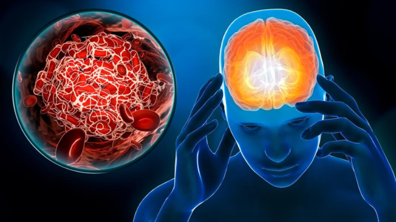 Chất chống oxy hóa có trong đậu xanh có tác dụng giúp ngăn ngừa đột quỵ
