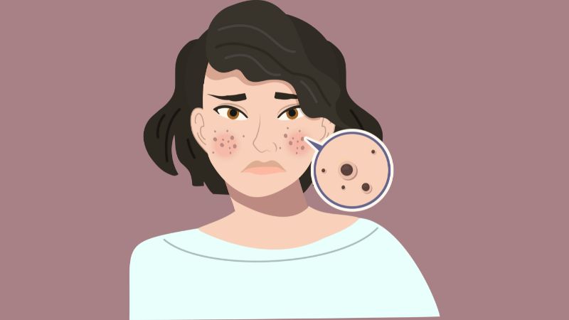 Nám da có thể xuất hiện dưới dạng các đốm nhỏ giống tàn nhang