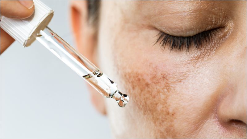 Nám da có thể biến mất hoàn toàn khi được điều trị và chăm sóc đúng cách