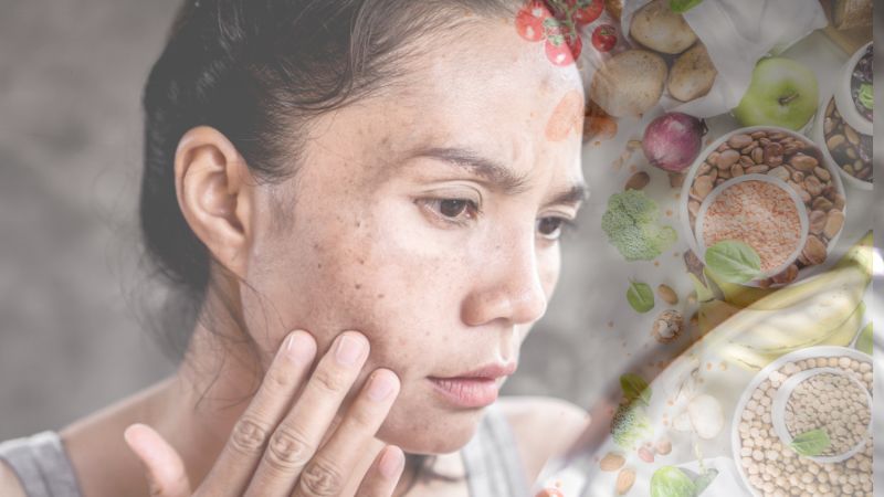 Chưa có bằng chứng cho thấy thực phẩm có thể trực tiếp gây ra nám da