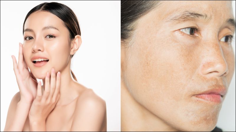 Làn da sẫm màu có nguy cơ bị nám da cao hơn làn da sáng màu