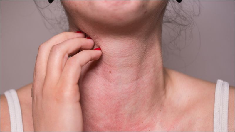 Da bị dị ứng khiến da dễ bị tổn thương làm tăng nguy cơ nám da