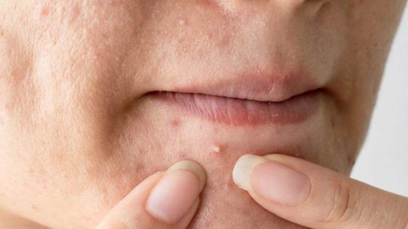 Nặn mụn có thể khiến da bị tổn thương, viêm hoặc nhiễm trùng và tăng nguy cơ hình thành sẹo mụn