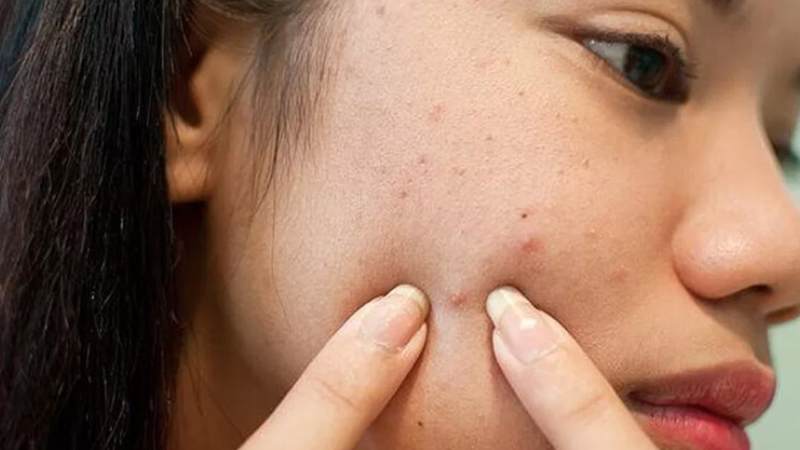 Nặn mụn thường xuyên gây tổn thương lớp biểu bì, làm mụn sưng đỏ, lâu lành và dễ để lại sẹo