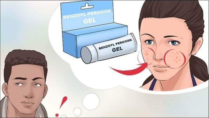 Các sản phẩm chứa benzoyl peroxide thường được dùng đầu tiên để điều trị mụn