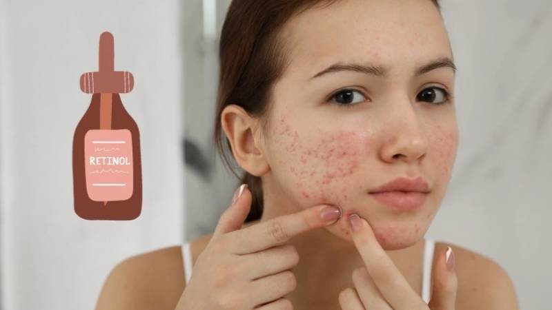 Một lựa chọn điều trị mụn khác là dùng retinoid